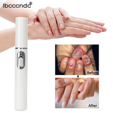Load image into Gallery viewer, 1 Pcs Anti-fungal Home Set Laser Pen Finger Toe Nail Fungus Care Kit(White ) TSLM1