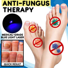 Load image into Gallery viewer, 1 Pcs Anti-fungal Home Set Laser Pen Finger Toe Nail Fungus Care Kit(White ) TSLM1